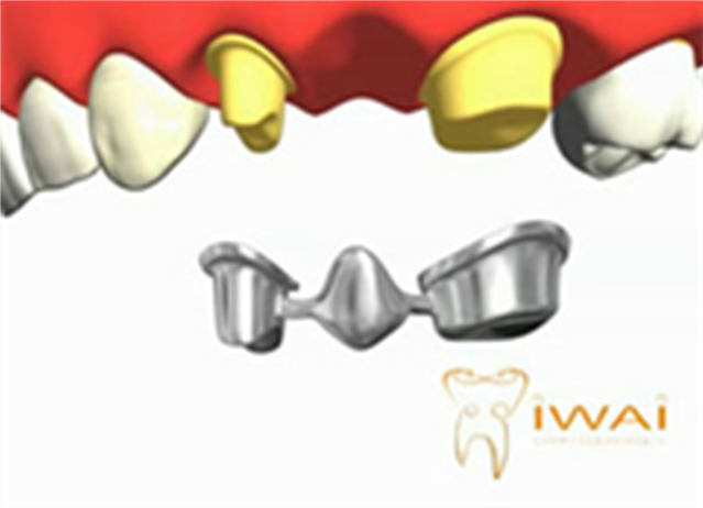 Confecção de prótese parcial fixa sobre dentes