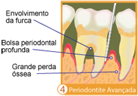 periodontite avancada
